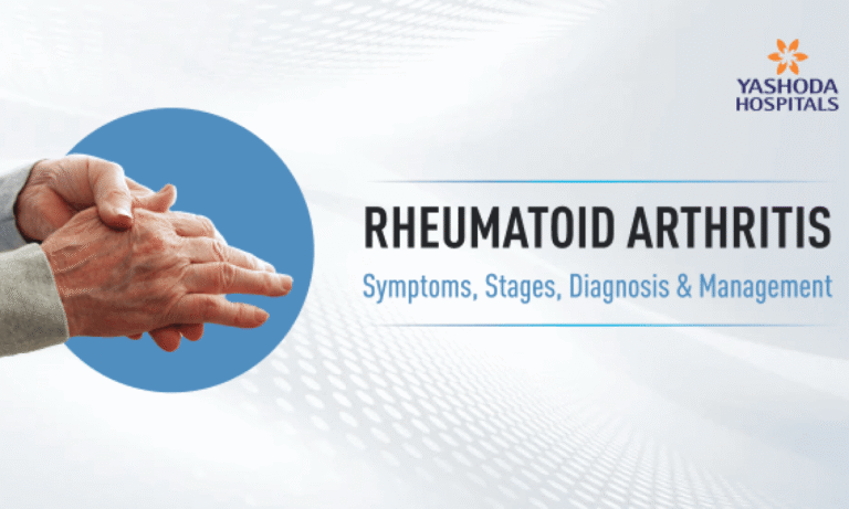 Rheumatoid Arthritis: Understanding the Condition, Symptoms, Causes, and Effective Treatments