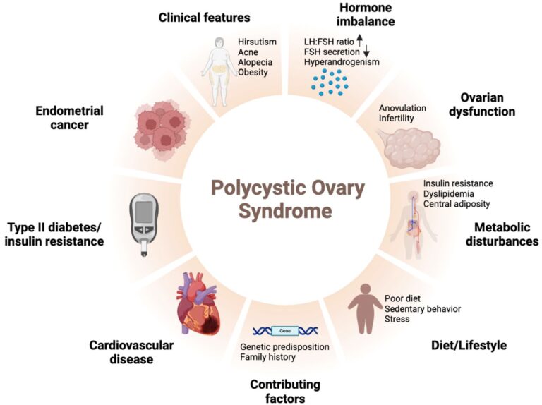 PCOS (Polycystic Ovary Syndrome): Symptoms, Causes, and Treatment Options