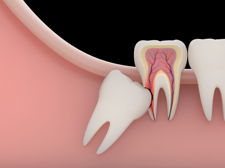Wisdom Teeth: Everything You Need to Know About Causes, Symptoms, and Removal